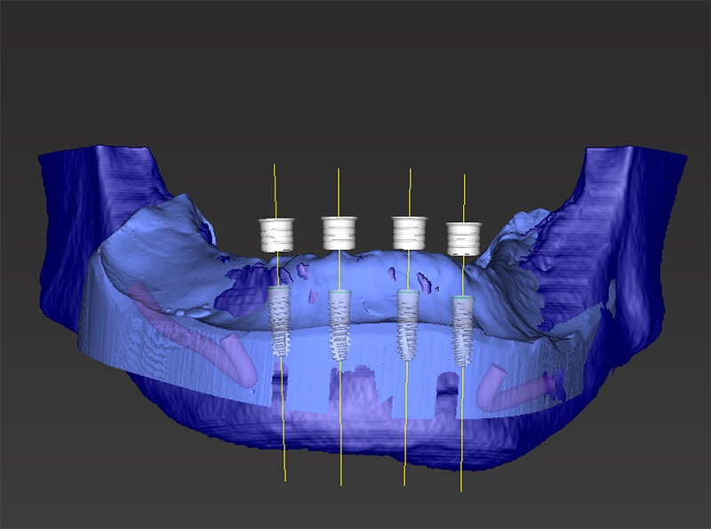 Moderne Zahntechnik Technologie bei Heberle Dental