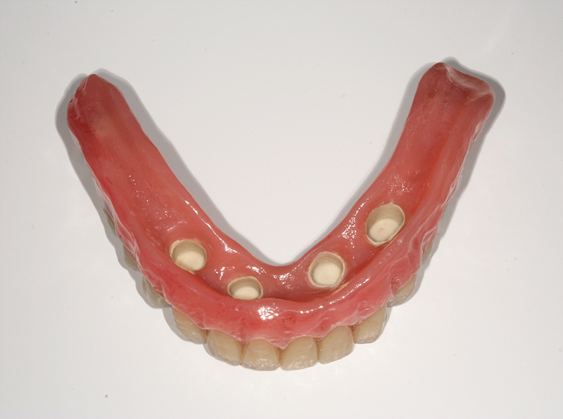 PEEK Zahnersatz bei Heberle Dental – Hochleistungspolymer Prothese