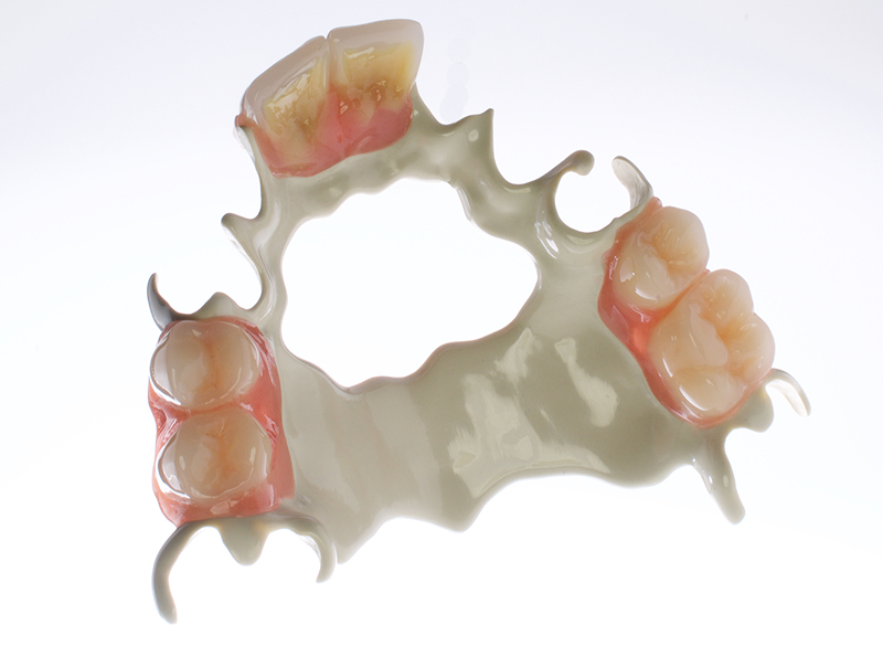 Ultaire AKP Prothese bei Heberle Dental – metallfreie Teilprothese